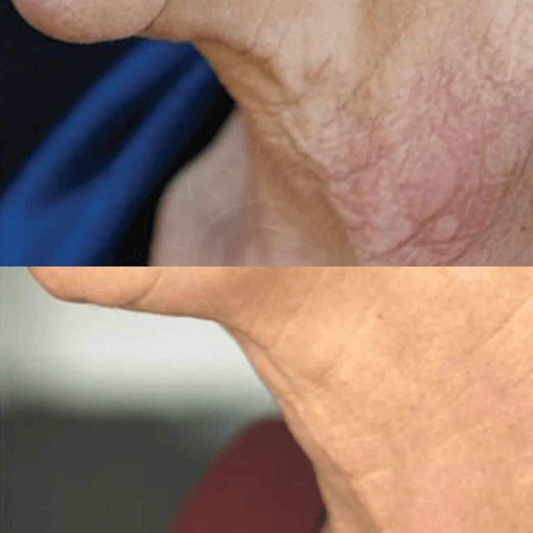 Anti-Aging Nitric Oxide Activating Serum 5 before and after nitric oxide activating serum neck