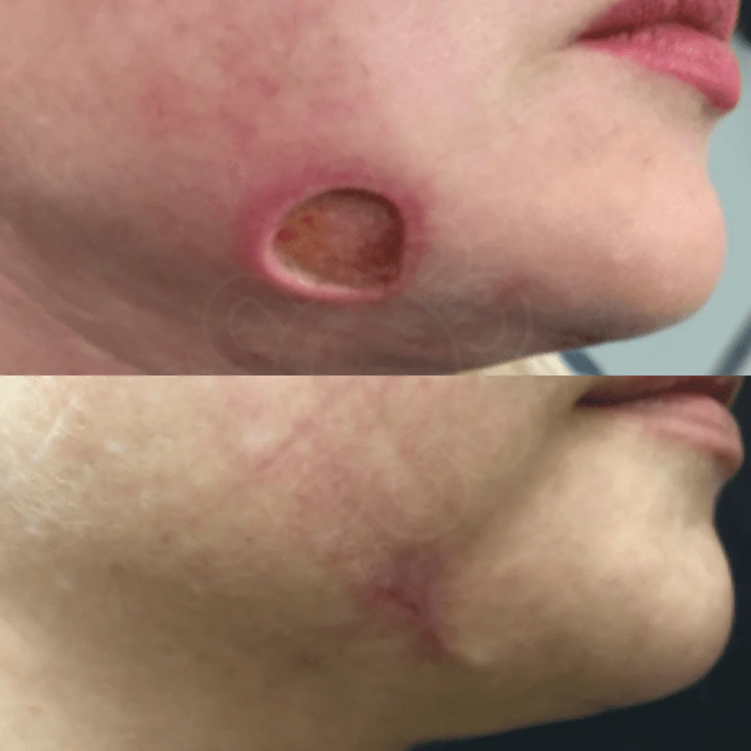 Anti-Aging Nitric Oxide Activating Serum 7 before and after nitric oxide activating serum on a face injury