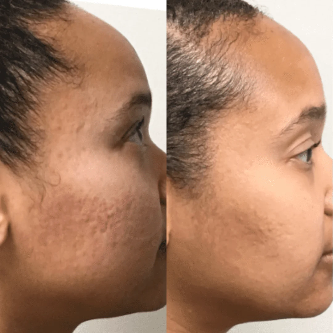 Anti-Aging Nitric Oxide Activating Serum 6 before and after nitric oxide activating serum on a african woman face