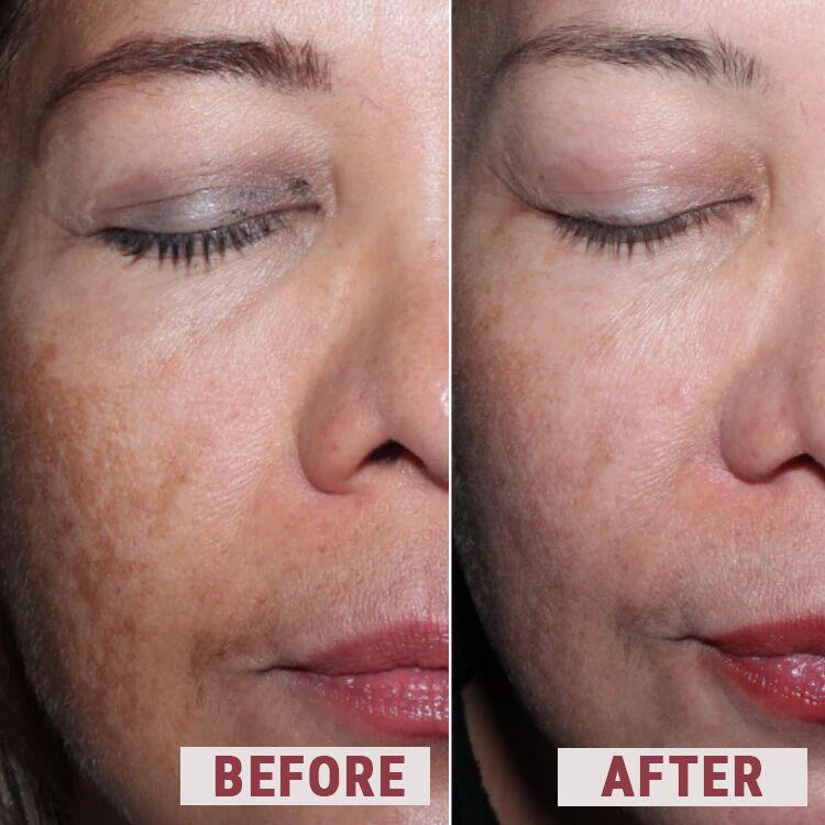 Elevai Enfinity Serum 5 before after comparison 2