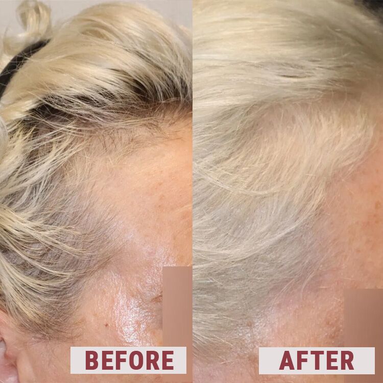 Elevai Enfinity Serum 3 before after hair loss